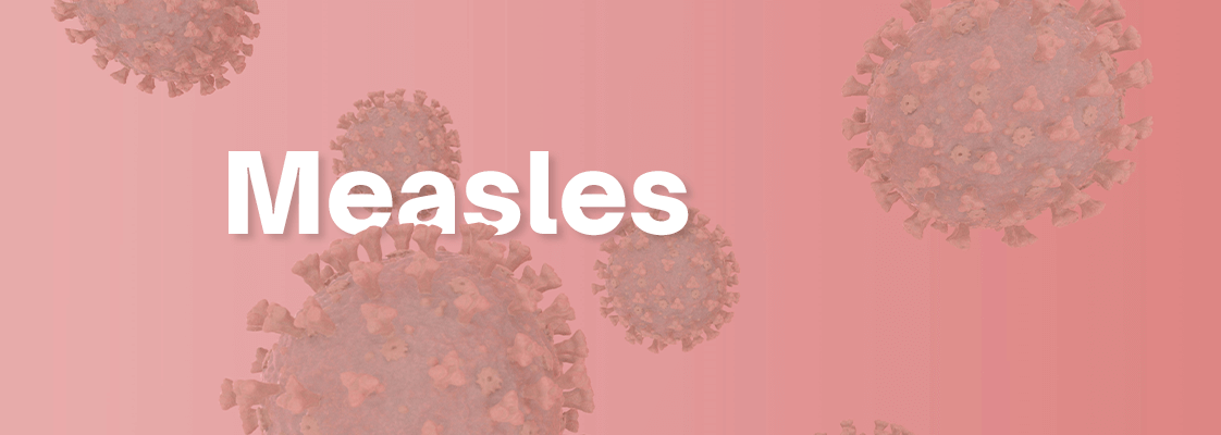 Measles